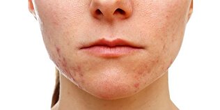 این خوراکی ها باعث آکنه می شوند