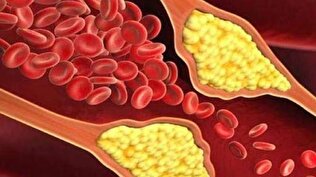 این علامت مهم ابتلا به کلسترول خون است