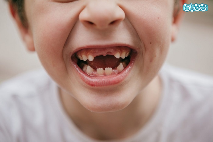 افتادن دندان شیری در ۵ سالگی اشکالی دارد؟