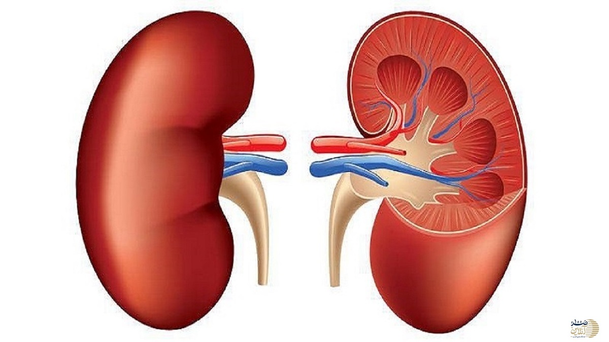 علت تشکیل سنگ کلیه + فیلم