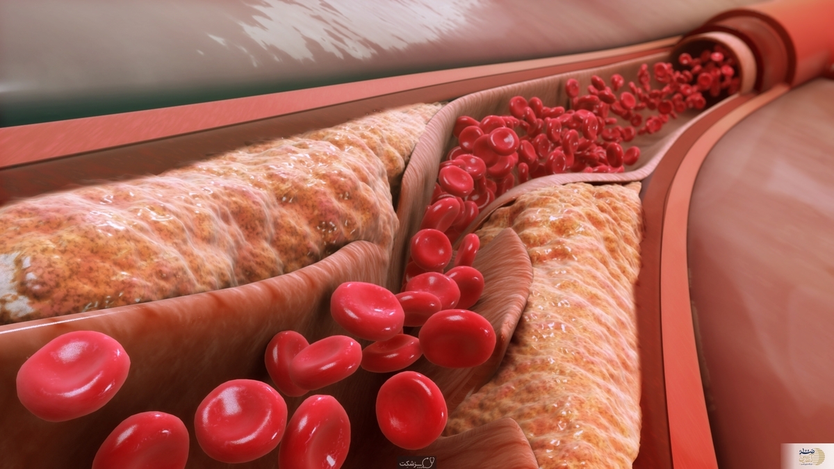 چرا کلسترول خون افزایش می یابد؟