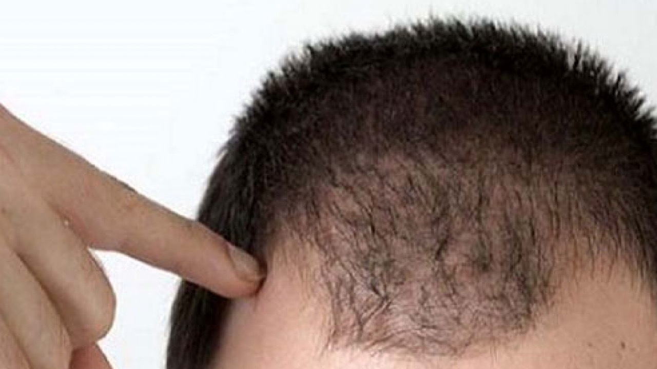 روش‌های مختلف جلوگیری از ریزش مو