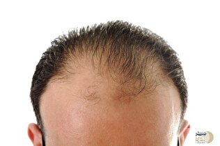 مهم ترین علت ریزش مو را بشناسید