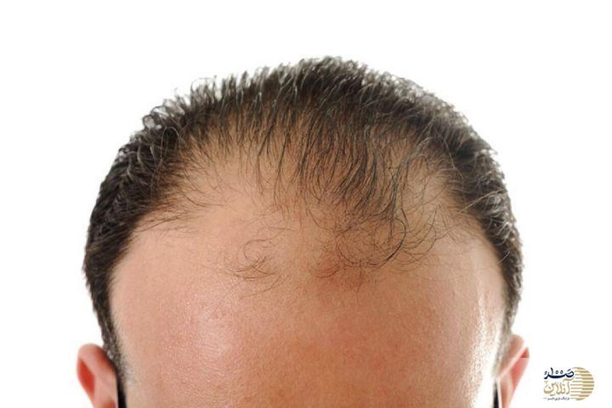 مهم ترین علت ریزش مو در مردان و زنان