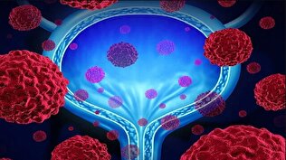 درمانی جدید برای بهبود مشکلات مثانه
