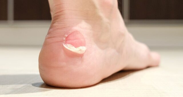 چگونه از تاول زدن پیشگیری کنیم؟ چگونه از تاول زدن پیشگیری کنیم؟