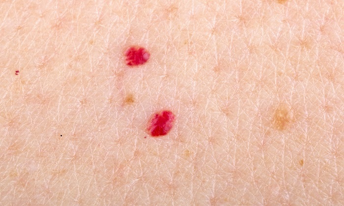 علت های ظاهر شدن لکه های قرمز روی پوست