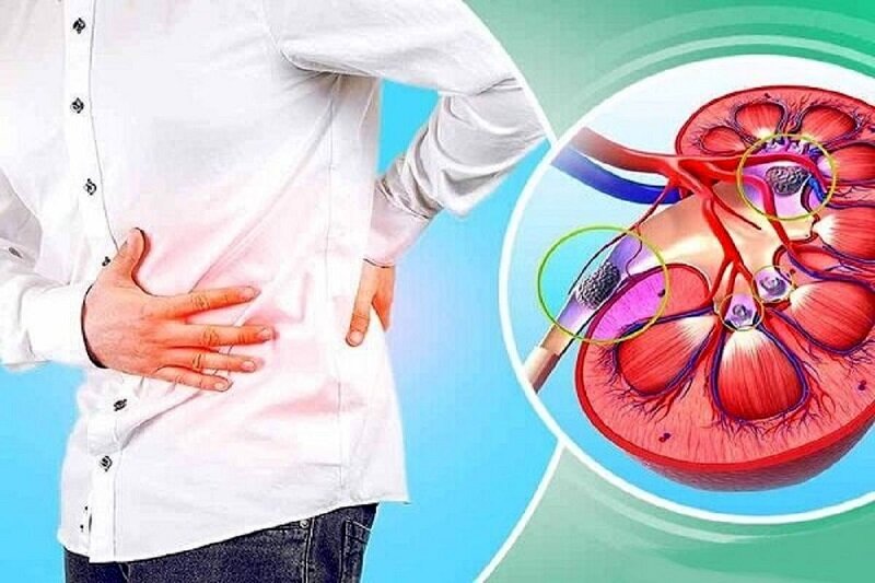 با این کارها از سنگ کلیه در امان بمانید