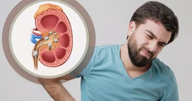 با این کارها از سنگ کلیه در امان بمانید