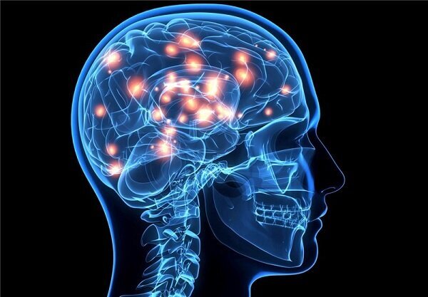 تجمع آهن در مغز پس از ضربه مغزی تجمع آهن در مغز پس از ضربه مغزی