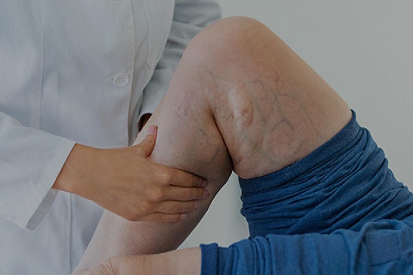 علائم واریس پا در زنان چیست و چگونه درمان می شود؟
