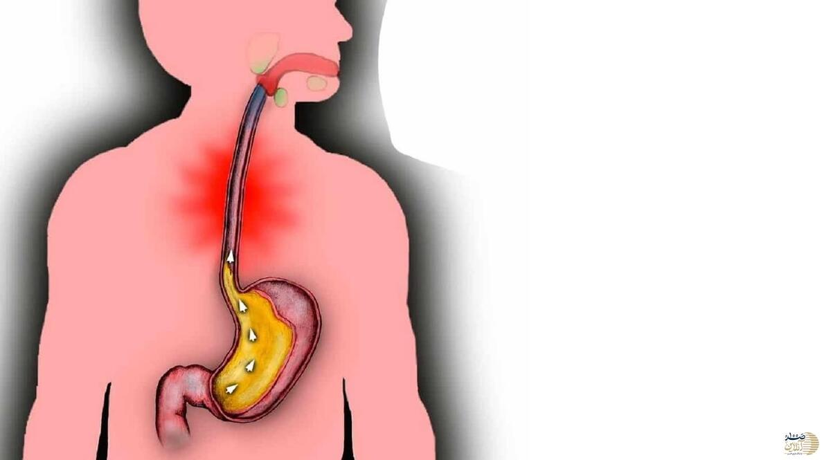 اثر عجیب و باور نکردنی پوشیدن لباس تنگ روی رفلاکس معده + عکس