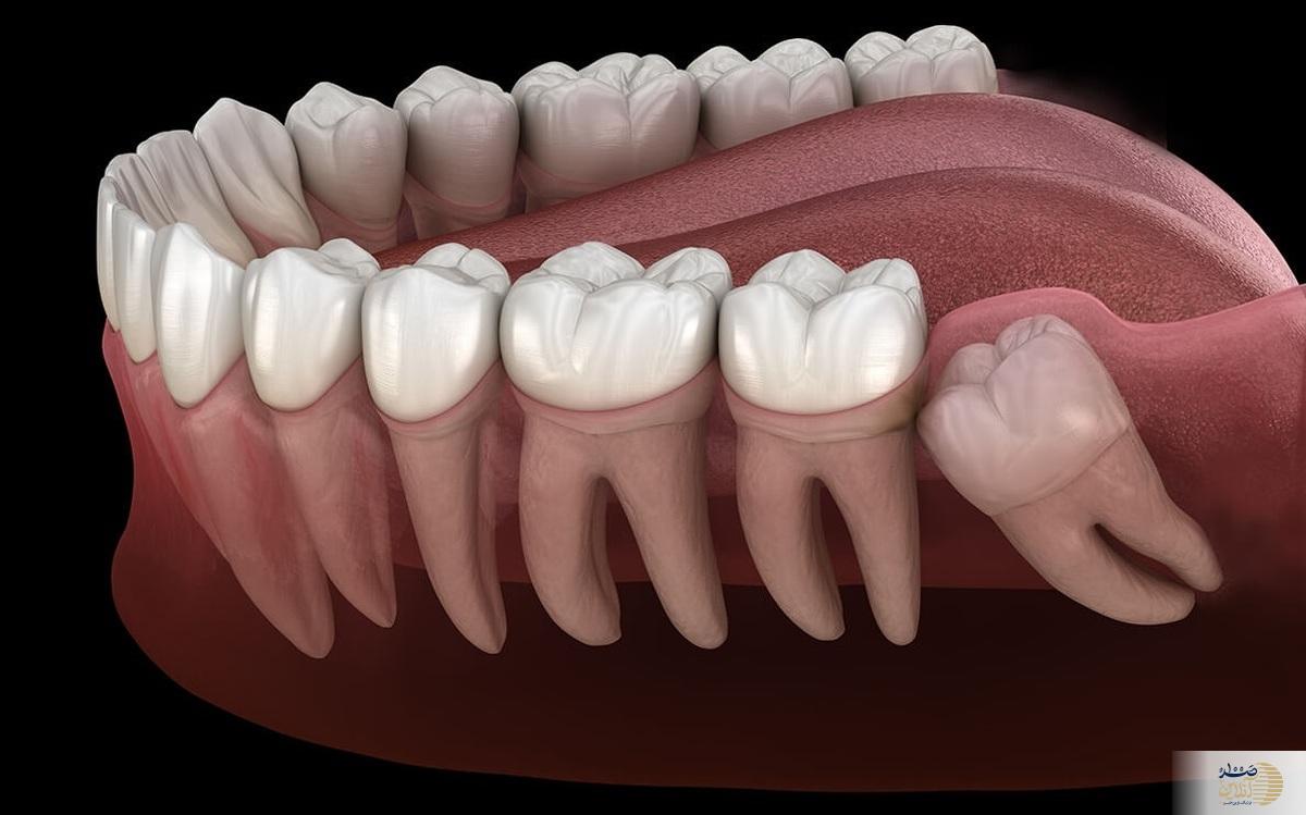 عمر ایمپلنت دندان به چه عواملی بستگی دارد؟