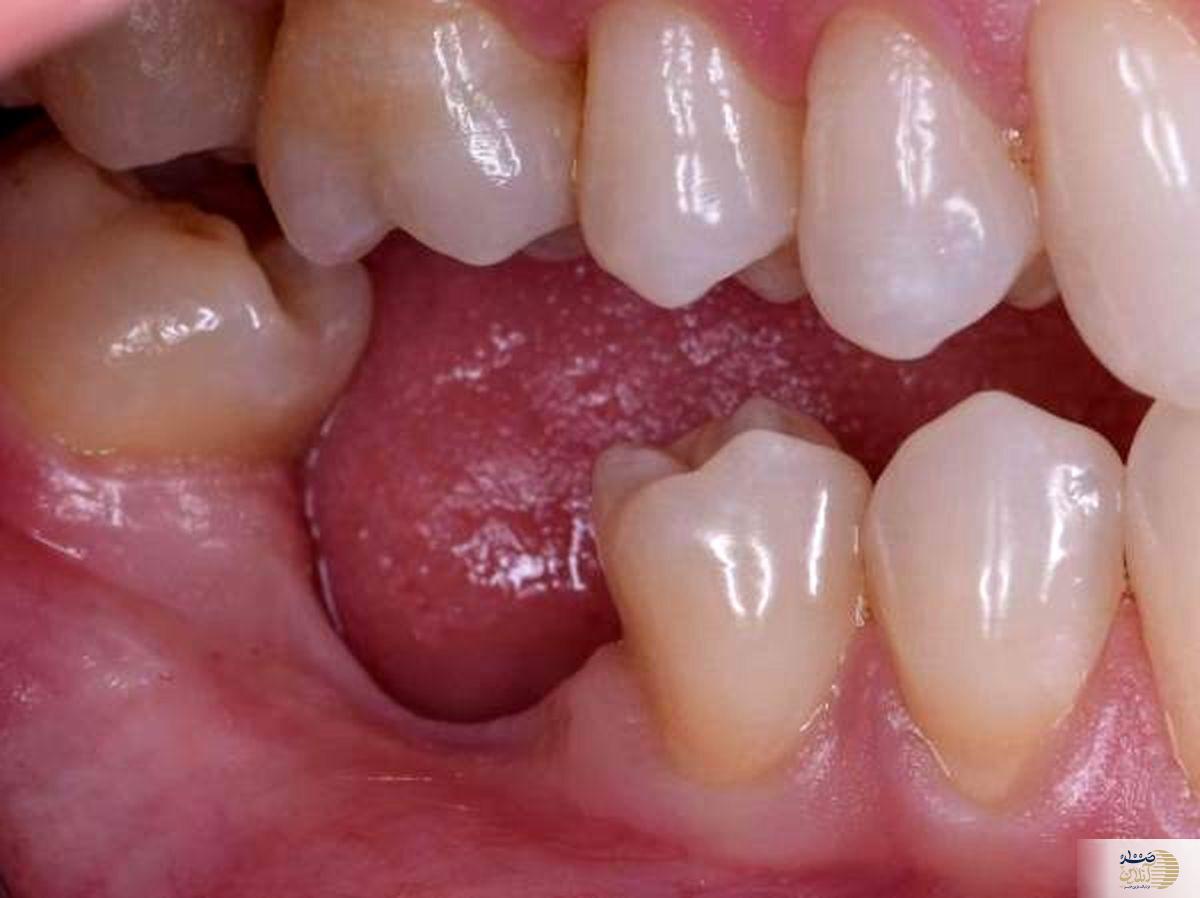 هشدار جدی برای کسانی که دندان ندارند | عوارض جدی حتی نداشتن یک عدد دندان در دهان