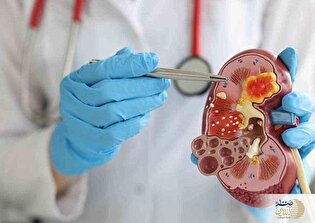 دفع سنگ کلیه با خوراکی‌های طبیعی در ناشتای صبح / با این روش پزشکان بیکار می شوند