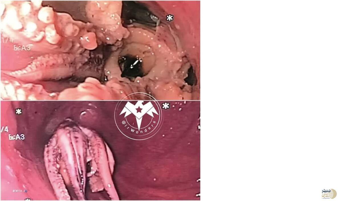 پزشکان یک اختاپوس کامل را از بیمار مبتلا به معده درد خارج کردند + عکس