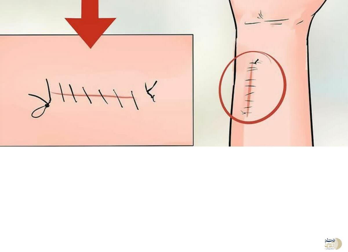 درمان سریع بخیه سزارین و هر بخیه دیگر و ترمیم زخم‌ها +روش گیاهی