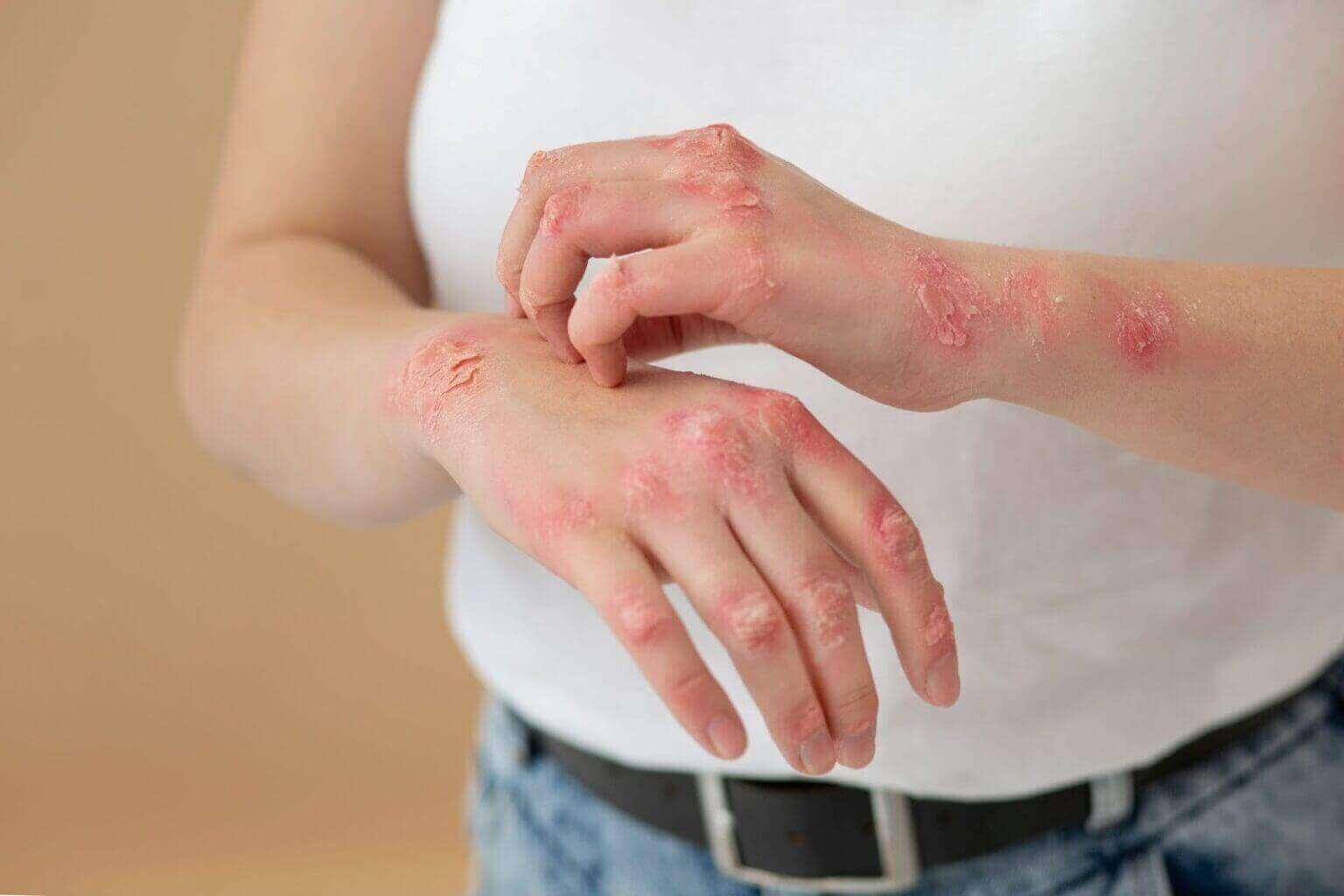 اگزما پوستی چیست و چه علائم و علت هایی دارد ؟
