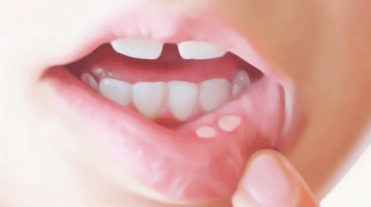 هشدار ! آفت دهان به بیماری‌های سیستم ایمنی بدن تعلق دارد