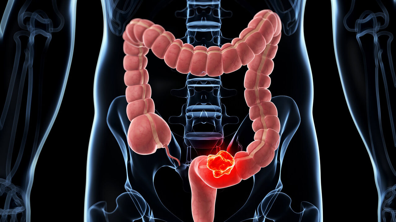 ۹ نشانه سرطان روده بزرگ که نباید نادیده بگیرید