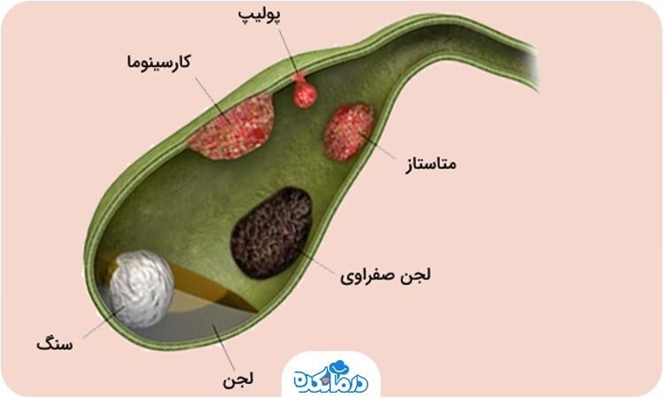 کیسه صفرا در کجا قرار دارد؟ کار آن چیست؟ (روزیاتو)