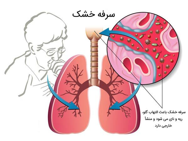 درمان سرفه خشک؛ راهکارهای خانگی ساده‌ای که می‌توانید امتحان کنید(زومیت)