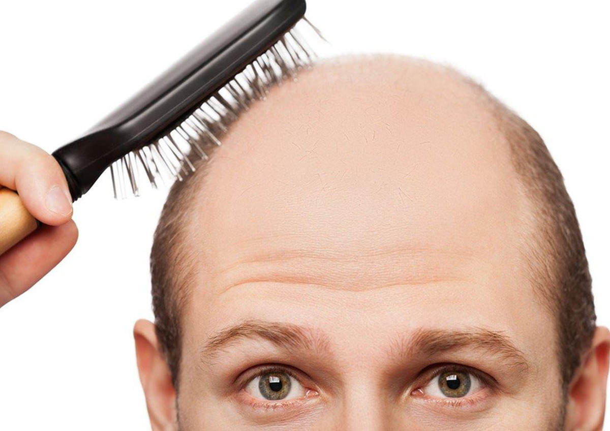 کلید درمان کامل طاسی و ریزش مو را بشناسید