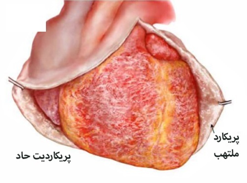 عوارض و علل بروز التهاب در ریه‌ها (صبح من)