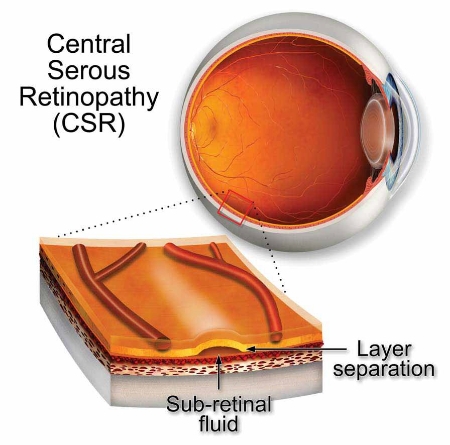 رتینوپاتی سروز مرکزی: همه چیز در مورد این بیماری چشمی (بیتوته)