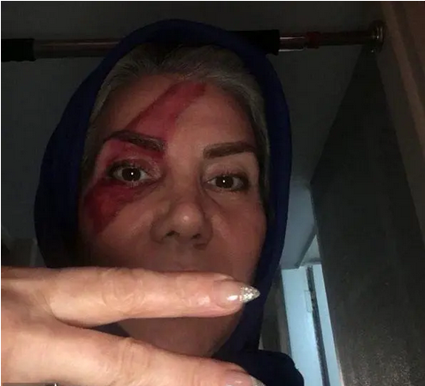 تتوی وحشتناک مادر تتلو روی صورت خودش