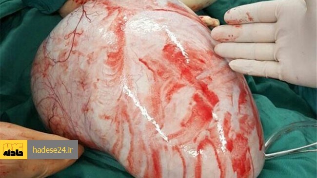عمل جراحی شگفت انگیز برای خروج توده ۲.۵ کیلویی از شکم زن کبودراهنگی