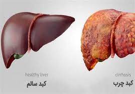 این مواد غذایی کبد چرب را درمان می‌کنند