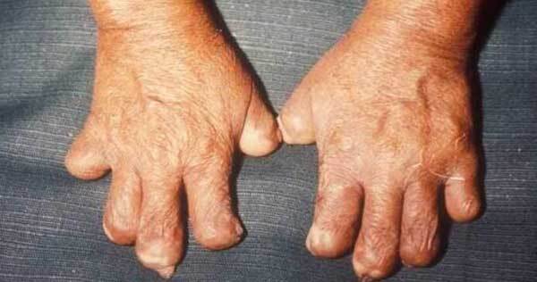 تاریخچه ی بیماری جذام تاریخچه ی بیماری جذام