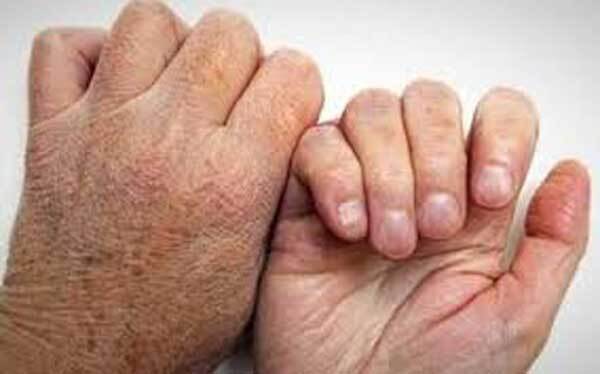 تاریخچه ی بیماری جذام تاریخچه ی بیماری جذام