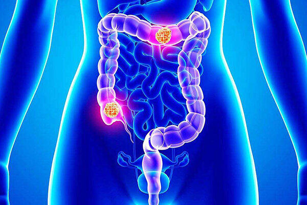 زنگ خطر افزایش سرطان روده بزرگ در ایران/سرطان‌ها مثل کوه یخ هستند