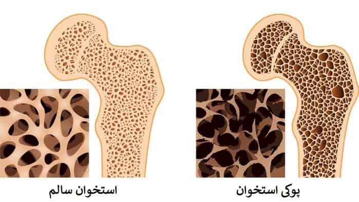 علائم پوکی استخوان و راه‌های درمان آن (فرارو)