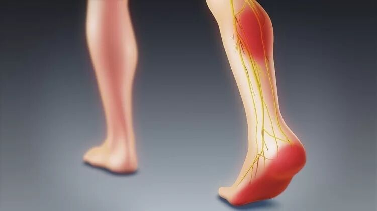 نشانه‌های دردهای سیاتیکدلیل دردهای لگنی و تیر کشیدن ساق پا را بشناسید