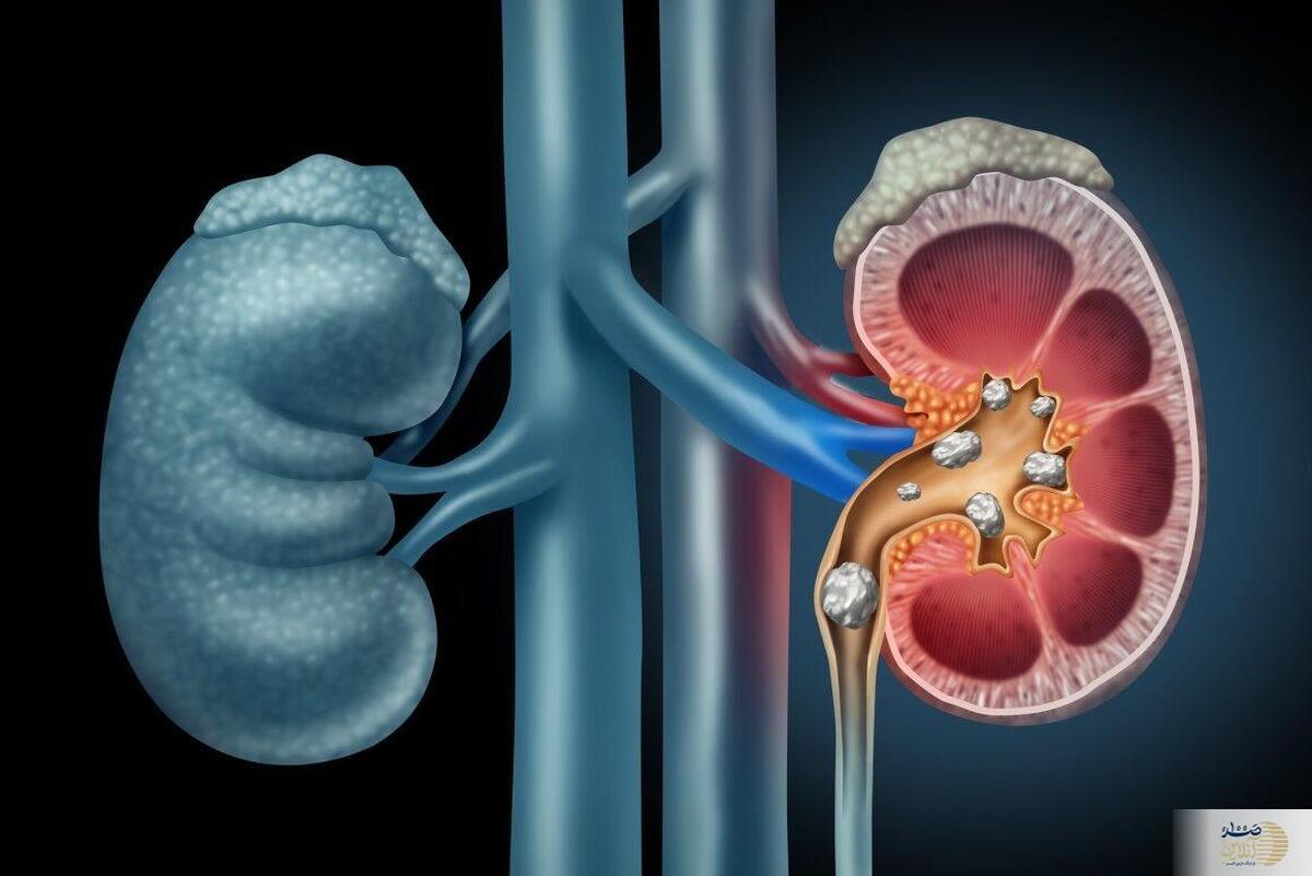 منفجر کنندگان سنگ کلیه در زمان باور نکردنی هشت میوه معرفی نشده هستند | فرصت را از دست ندهید