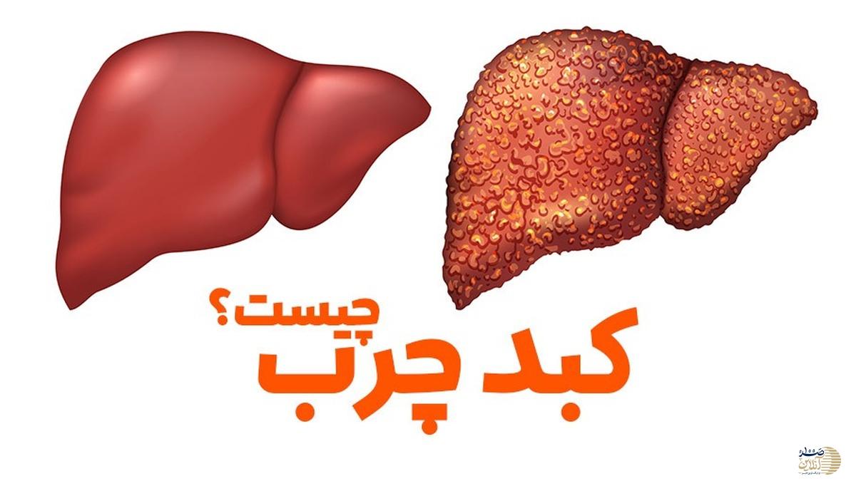 علائم نوعی سرطان کبد