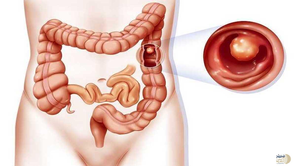 بعد از این سن حتما باید غربالگری سرطان روده را بدهید