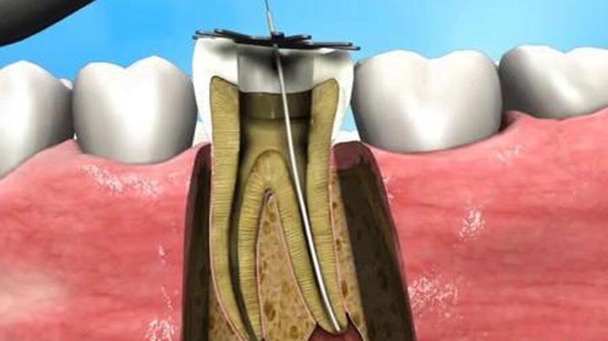 ببینید| دندان چگونه عصب کشی می‌شود؟