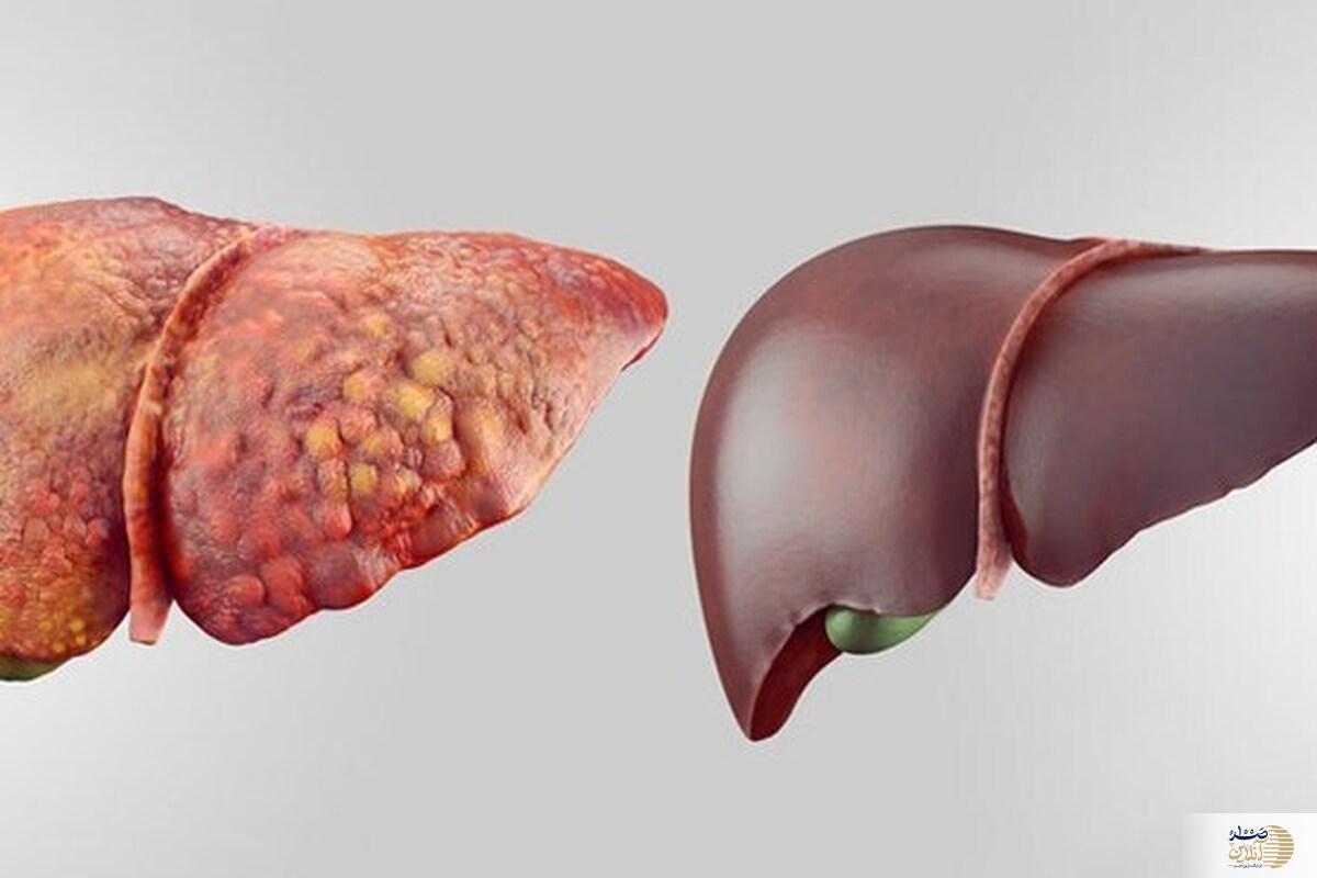ویدیو/ اگر کبدتان چرب است این ویدیو را از دست ندهید