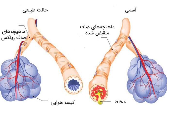 یک تحقیق تازه روی بیماری آسم، محرکی برای بروز بیماری مشخص کرد، که تا حالا متوجه آن نشده بودیم (یک پزشک)