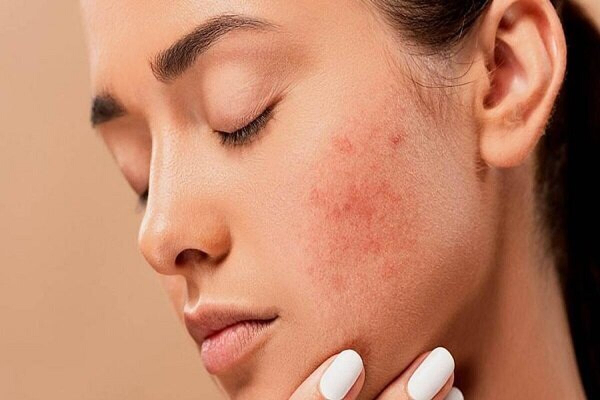جوش در بزرگسالان چگونه درمان می‌شود؟