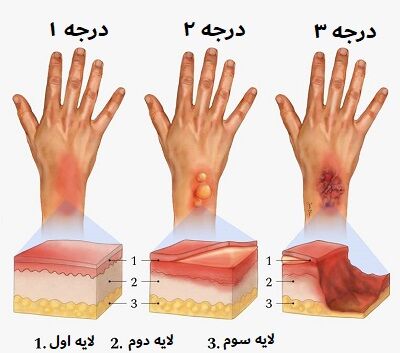  پماد سوختگی پوست