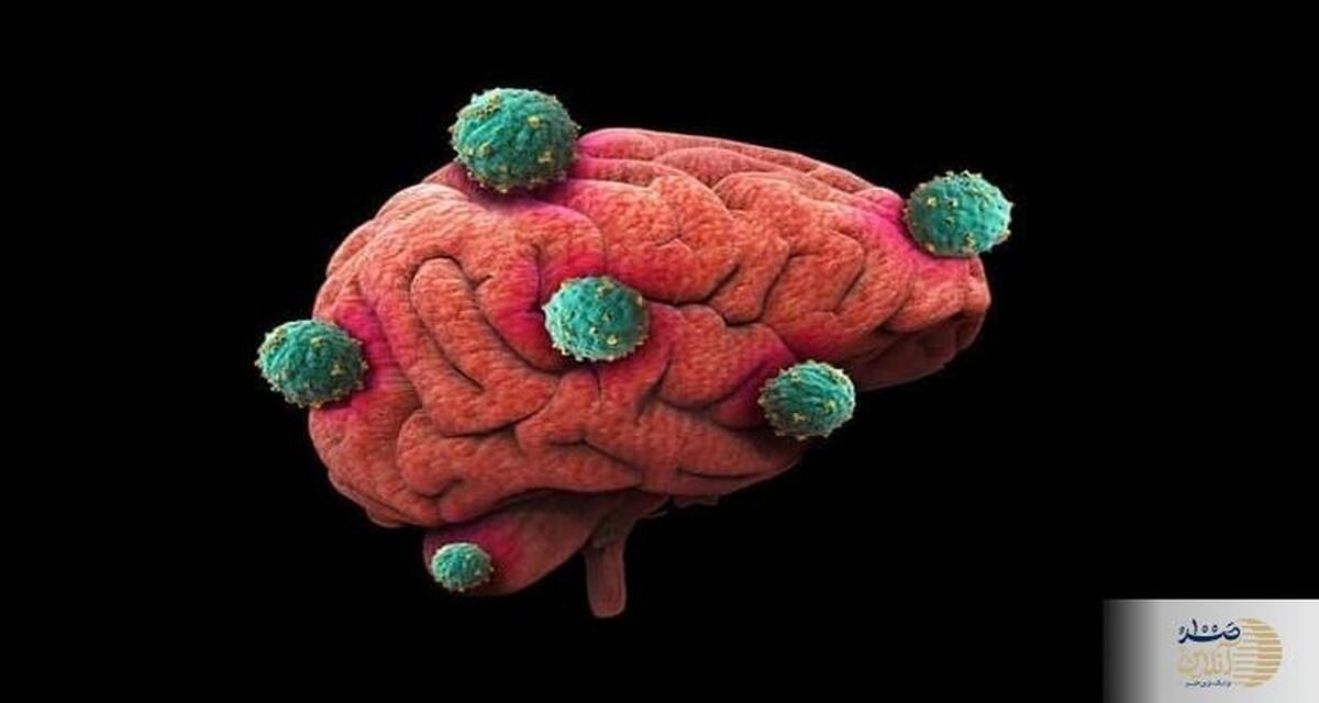 اولین علائم تومور مغزی چیست؟