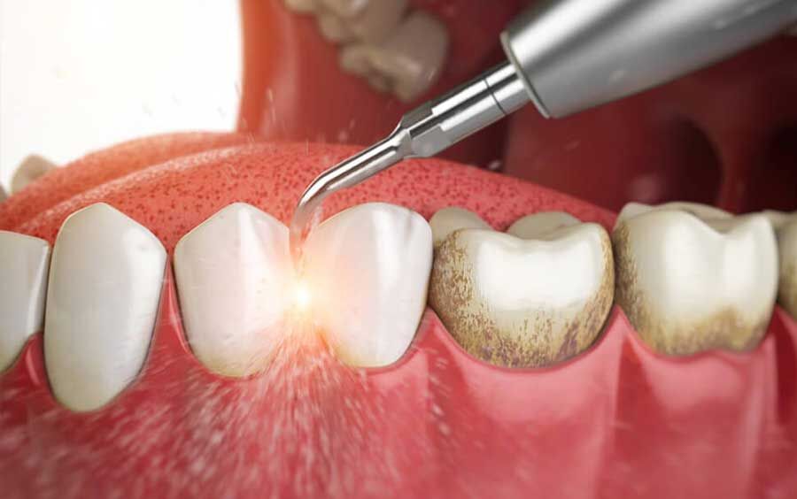 چرا باید جرم گیری دندان را جدی بگیریم؟