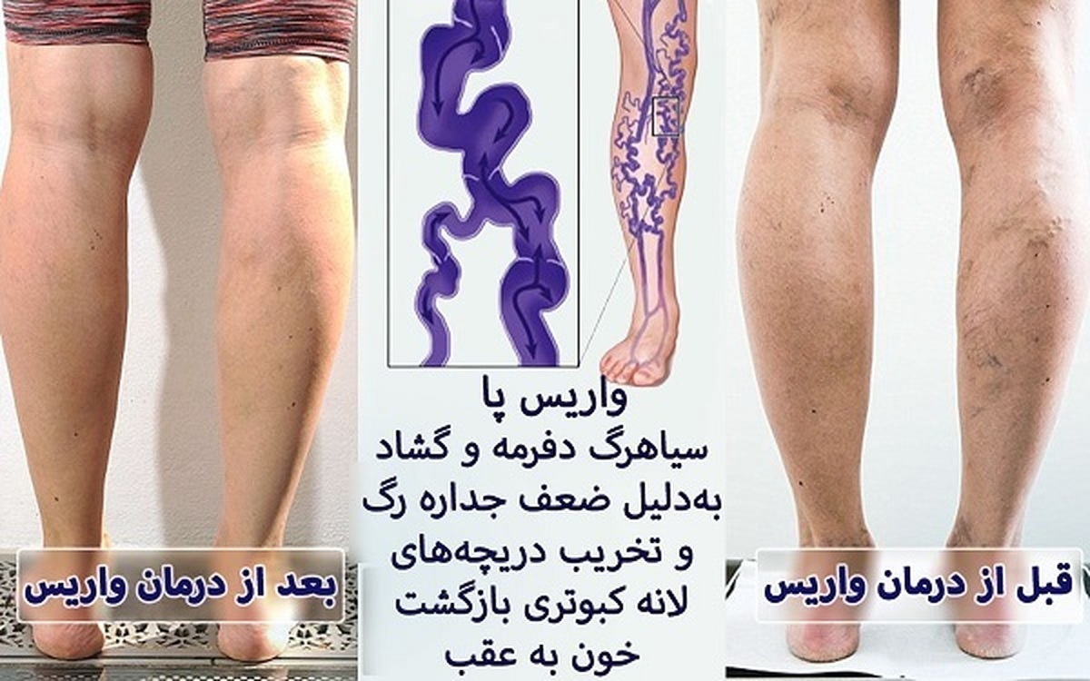 بیماری واریس برای کدام اندام‌های حیاتی خطرناک تر است؟