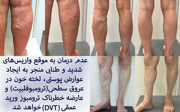 بیماری واریس برای کدام اندام‌های حیاتی خطرناک تر است؟
