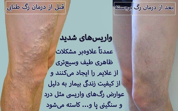 بیماری واریس برای کدام اندام‌های حیاتی خطرناک تر است؟